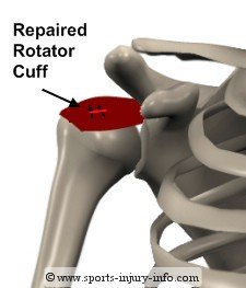 Rotator Cuff Surgery - Sports Injury Info